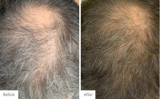 ProLuxe™ Scalp Treatment | Hair Care & Restoration