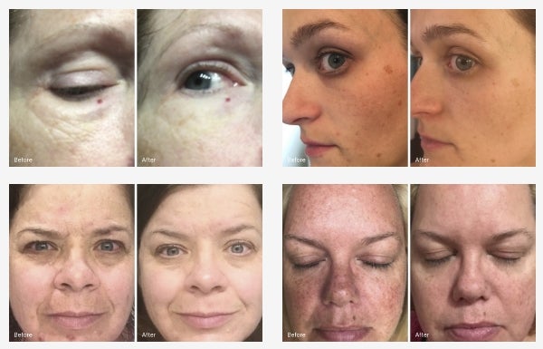 Before and after pictures of four different womens faces after using this set.