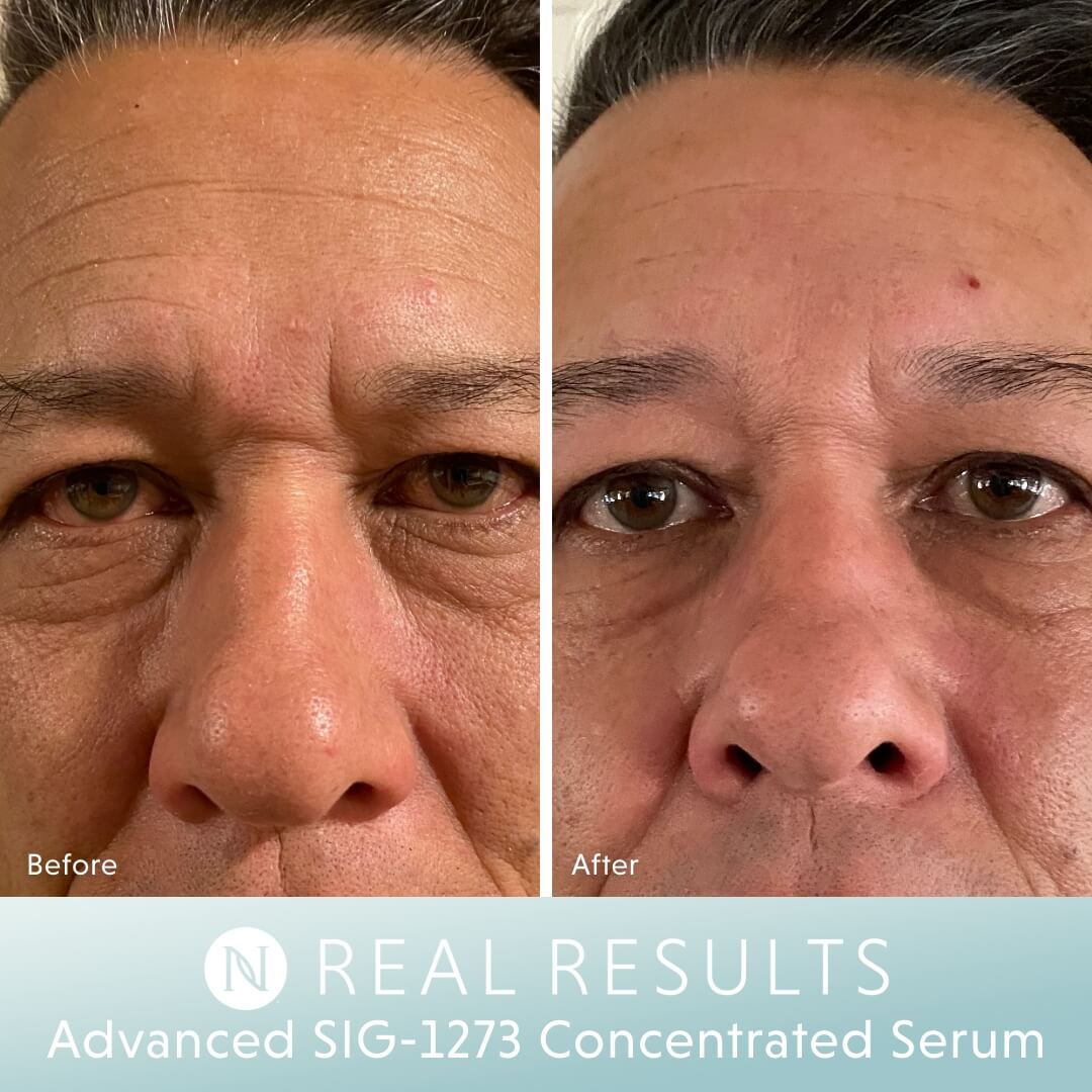 Sig Serum Real Results - John